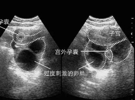 什么是残角子宫？残角子宫能做试管婴儿吗？