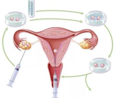 柳州2026试管婴儿费用要多少？附单周期收费明细参考
